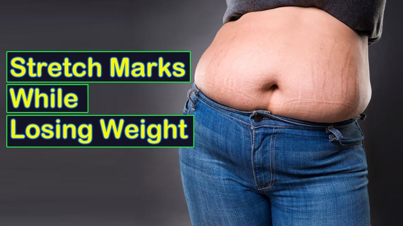 How Can You Prevent Stretch Marks While Losing Weight? - YouTube - Will Stretch Marks Go Away After Losing Weight