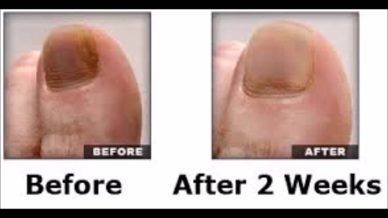 Lunavia Toenail Fungus Pen Reviews Consumer Reports