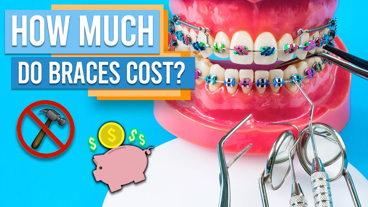 HOW MUCH DO BRACES COST? - YouTube - How Much Do Braces Cost In Albany