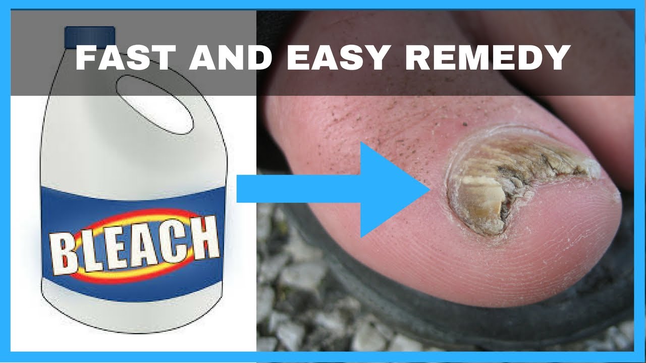How to Get Rid of Toenail Fungus with Bleach - Toe Fungus Journey - YouTube - Fungus Exodus For Toenail Fungus Reviews Before And After