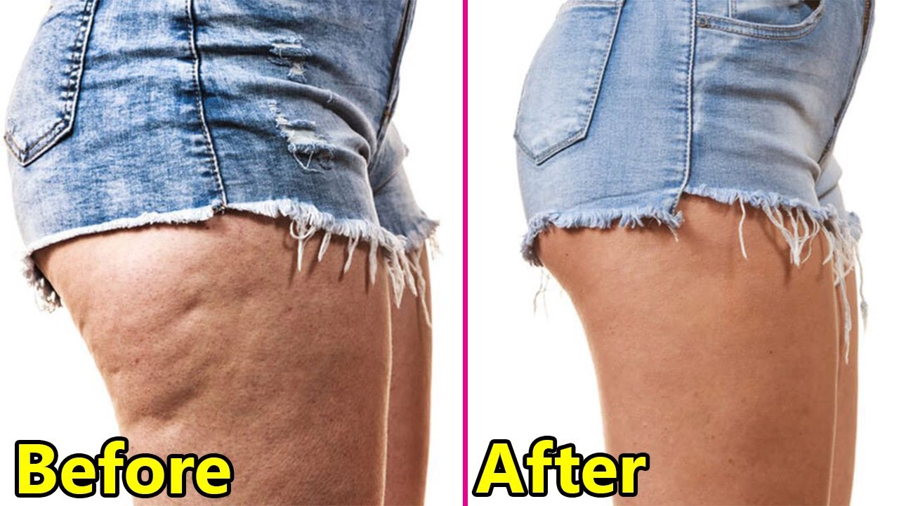 How to Remove Cellulite from the Back of Legs Just in 3 Days| How To - Does Cellulite Go Away When You Lose Weight