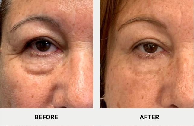 How To Tighten Skin Under Eyes