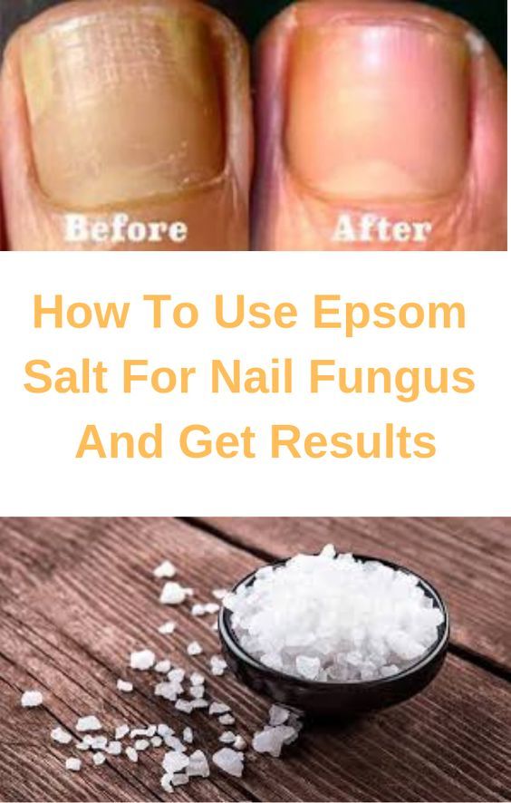 Soaking Feet In Epsom Salt For Toenail Fungus
