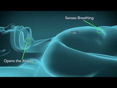 Inspire Therapy for Sleep Apnea - YouTube - How Much Does Inspire For Sleep Apnea Cost