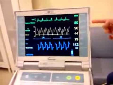 Intra Aortic Balloon Pump Class! - YouTube - Intra Aortic Balloon Pump Consoles Market