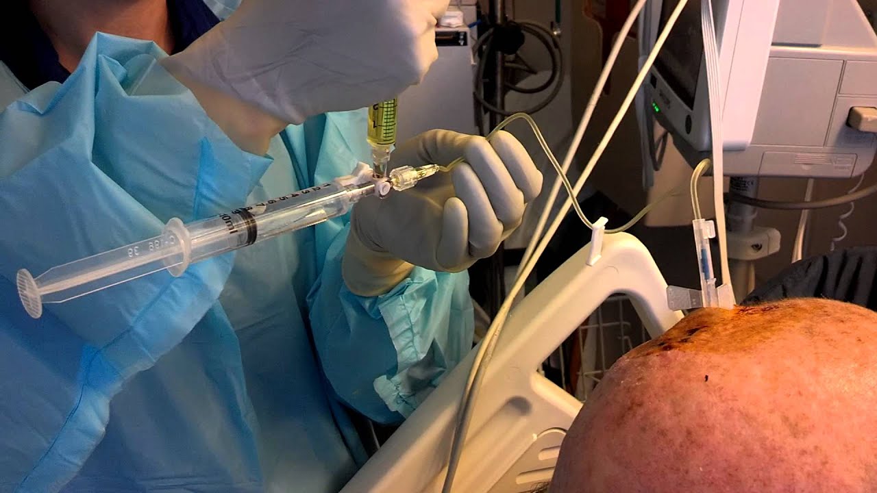 Intrathecal injection - YouTube - Intrathecal Injection Is Administered Into The