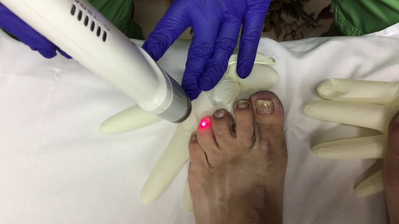 Laser Toenail Fungus Treatment - YouTube - At Home Laser Treatment For Toenail Fungus