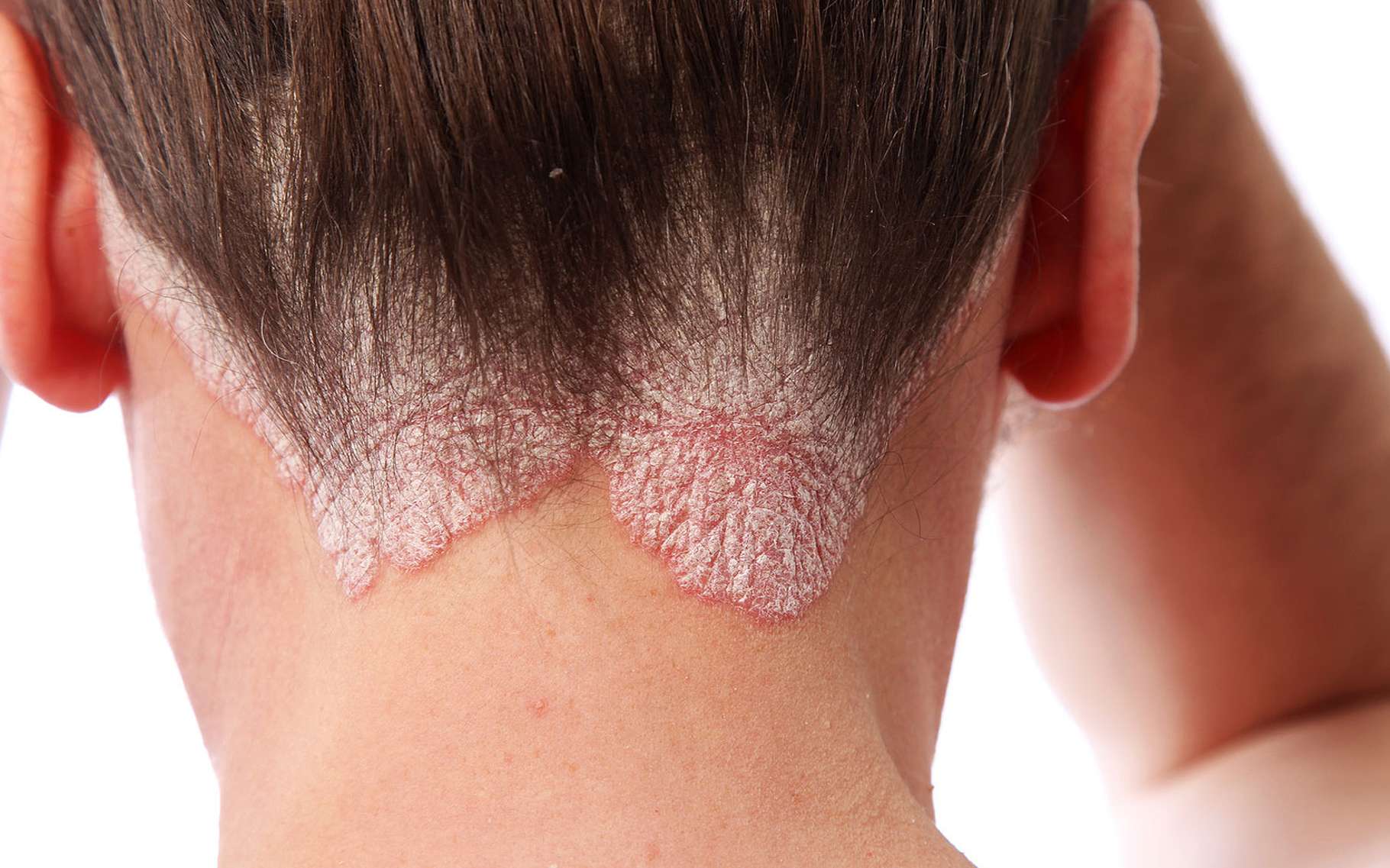 Can Psoriasis Cause High White Blood Cell Count