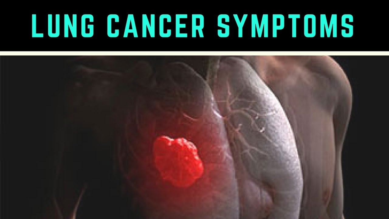 Lung Cancer Life Expectancy Causes Types Symptoms Stages - YouTube - Lung Cancer And Heart Failure Life Expectancy