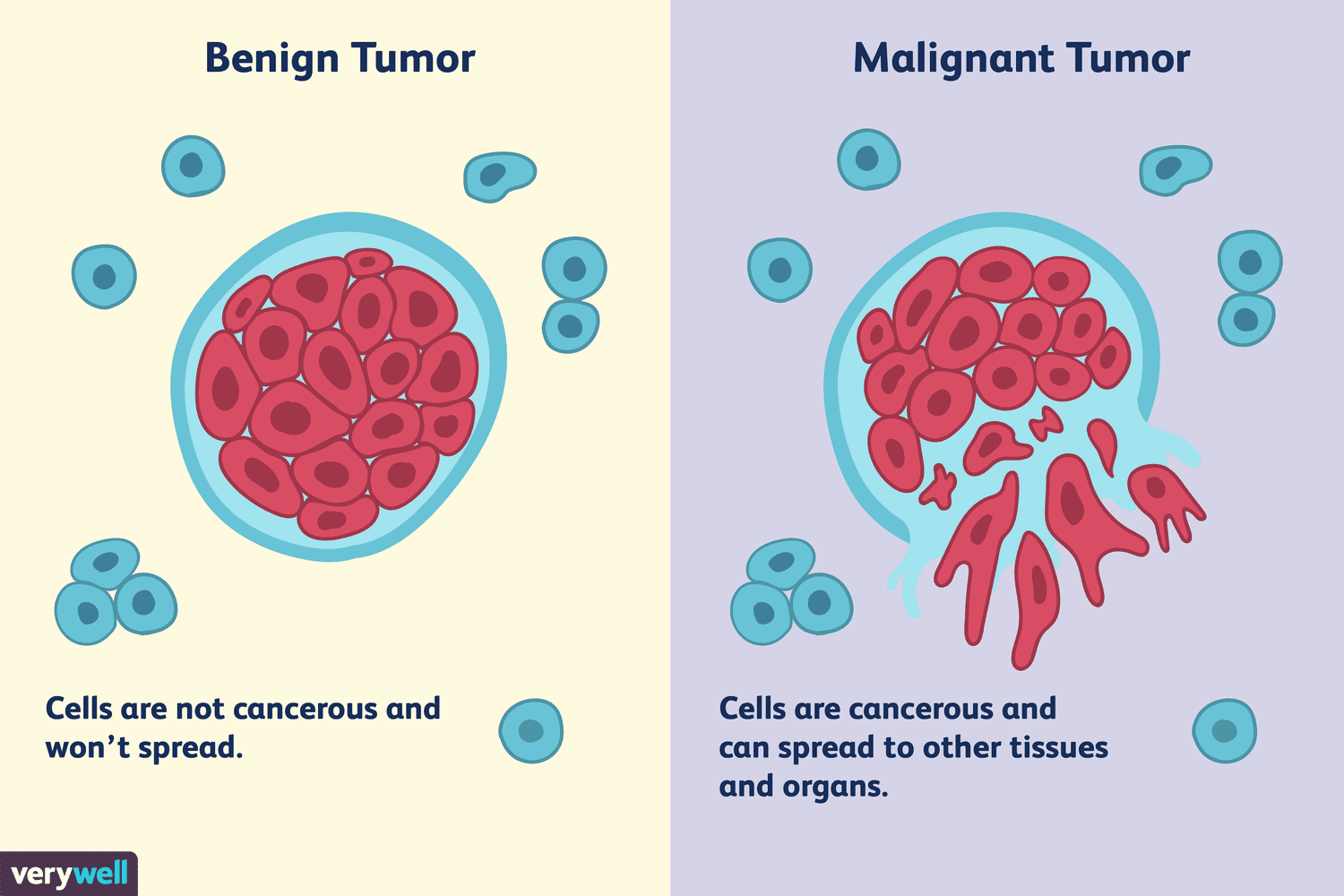 Benign Prostatic Hyperplasia Vs Prostate Cancer