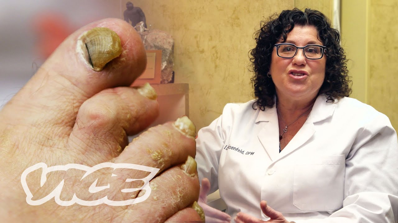 Fungus Exodus For Toenail Fungus Reviews Consumer Reports