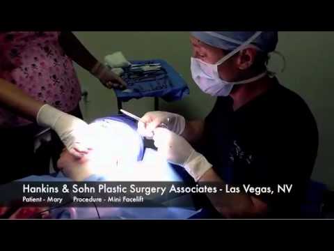 Mini Facelift Surgey Las Vegas - Hankins & Sohn Plastic Surgery - Hankins & Sohn Plastic Surgery Associates