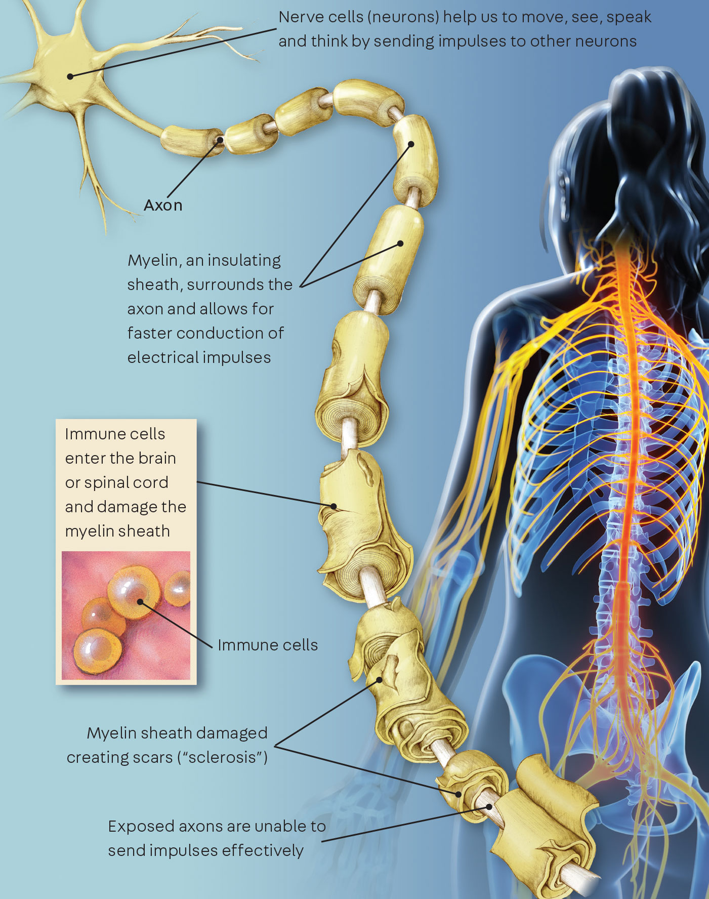 Multiple Sclerosis 101: What Patients Need to Know - Ms High White Blood Cell Count