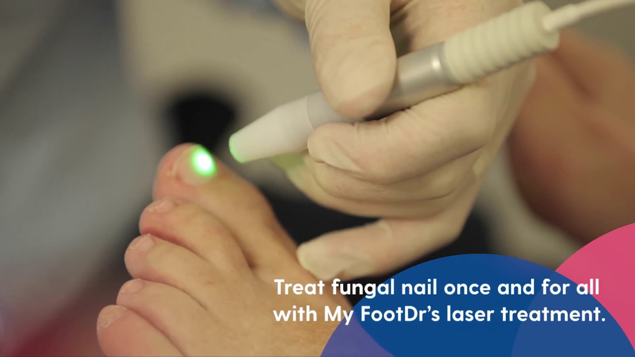 At Home Laser Treatment For Toenail Fungus
