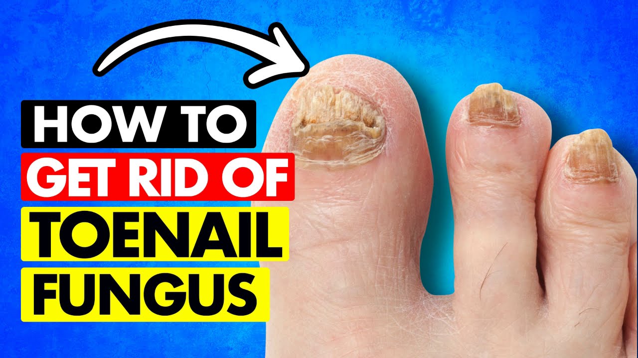 NASTY TOENAIL FUNGUS!!! How To Get Rid of It Now! - YouTube - Fungus Exodus For Toenail Fungus Reviews Before And After