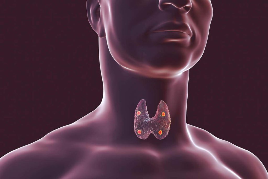 Otolaryngology Department lab identifies novel gene mutation in - Thyroid Supplements For Weight Loss Reviews