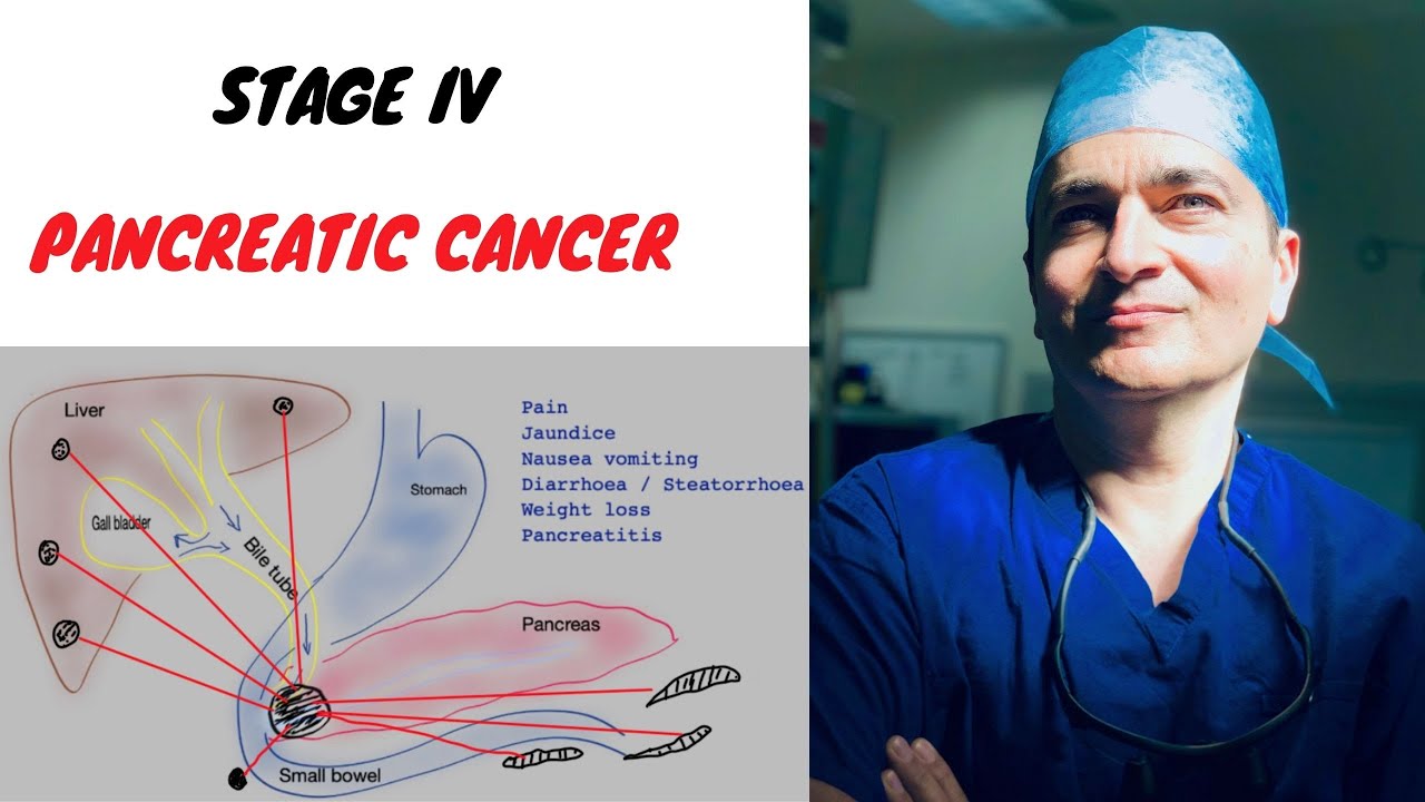 Stage 4 Neuroendocrine Pancreatic Cancer Life Expectancy