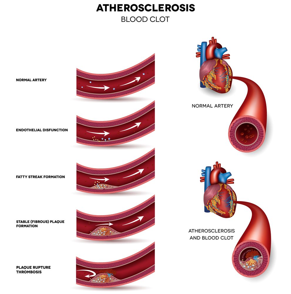 Pin on Health A-Z - Icd 10 End Stage Heart Disease