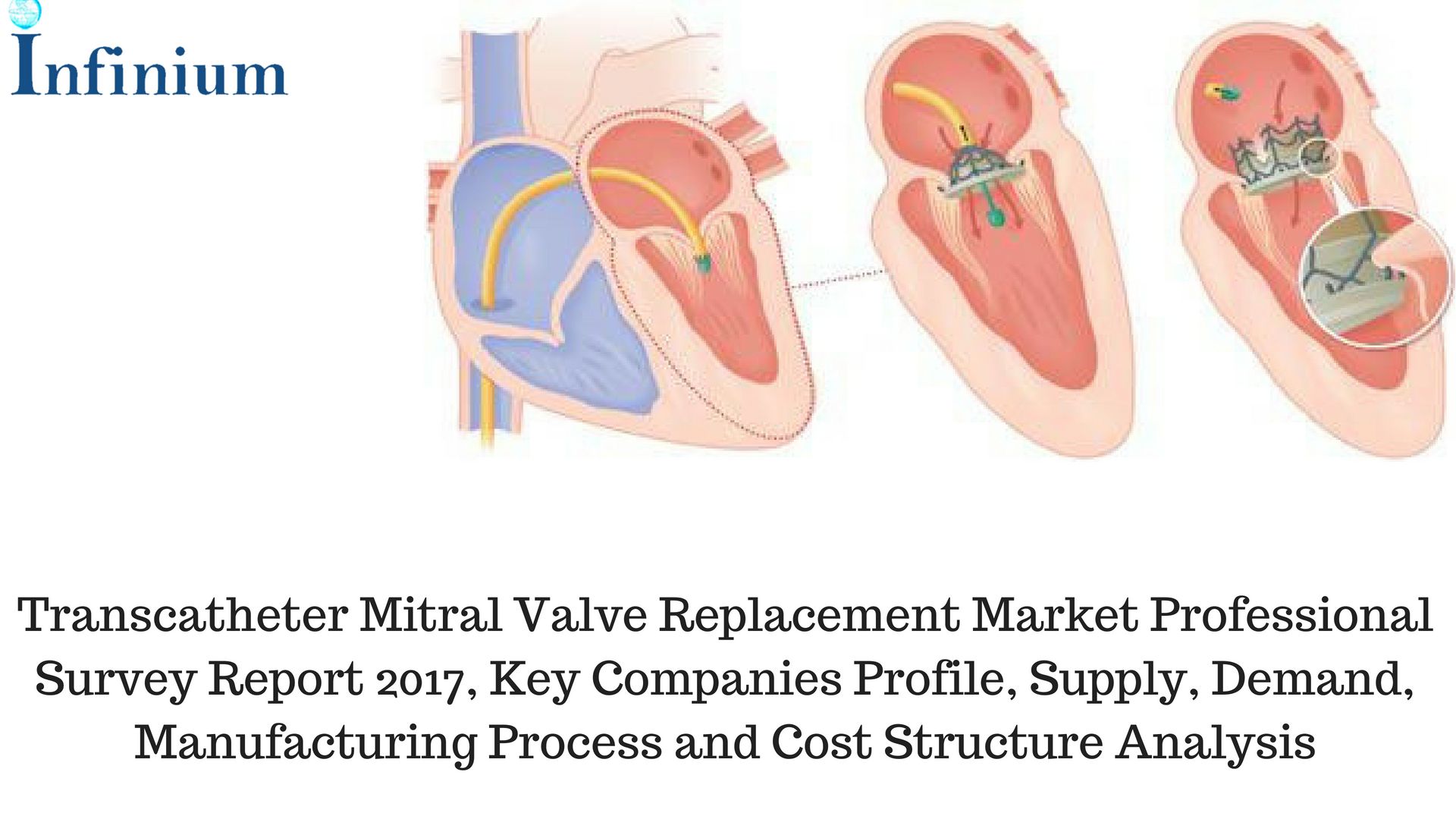 Pin on Infinium Global Research - Transcatheter Mitral Valve Repair Pipeline Product Market