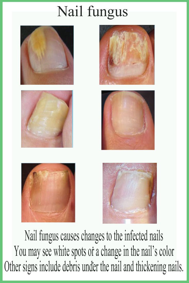 Nail Fungus From Press On Nails