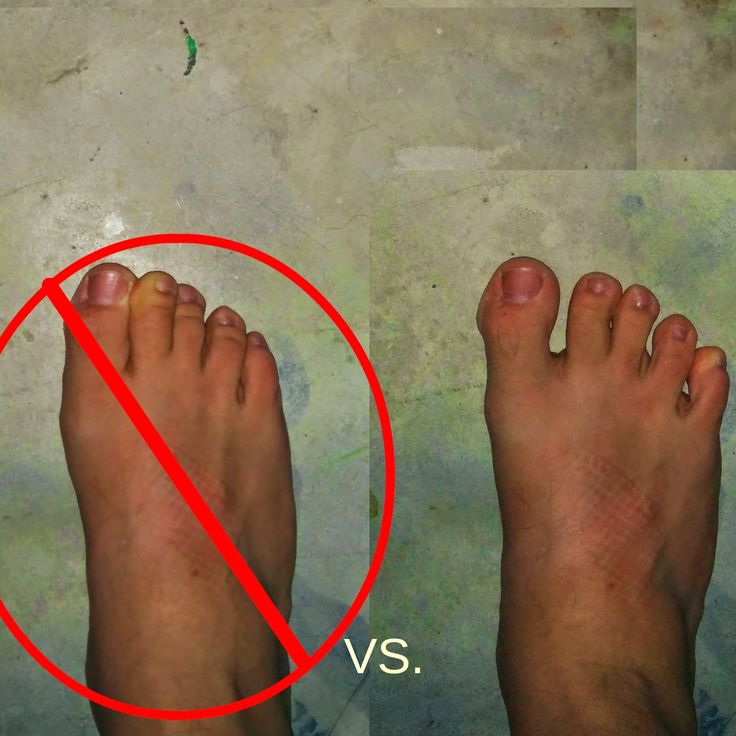 Does Losing Your Big Toe Affect Your Balance