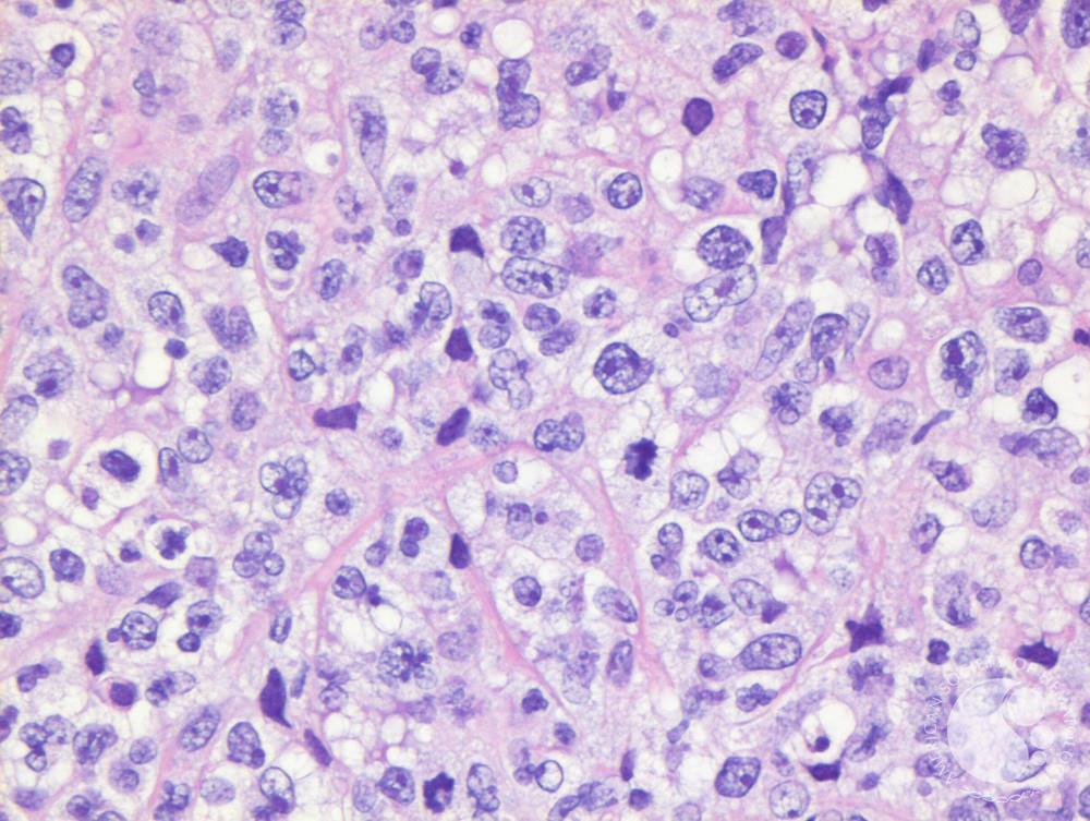 Primary Mediastinal B-cell Lymphoma - Primary Mediastinal B Cell Lymphoma Survival Rate
