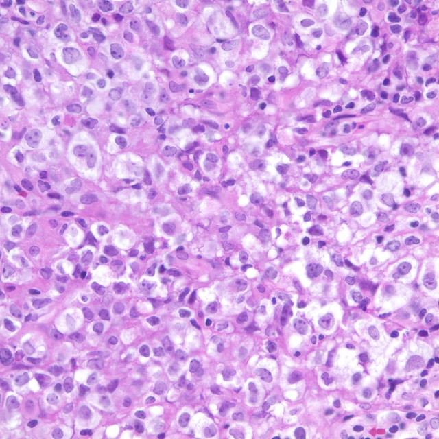 Primary Mediastinal Large B-Cell Lymphoma | Flickr - Photo Sharing! - Primary Mediastinal B Cell Lymphoma Survival Rate