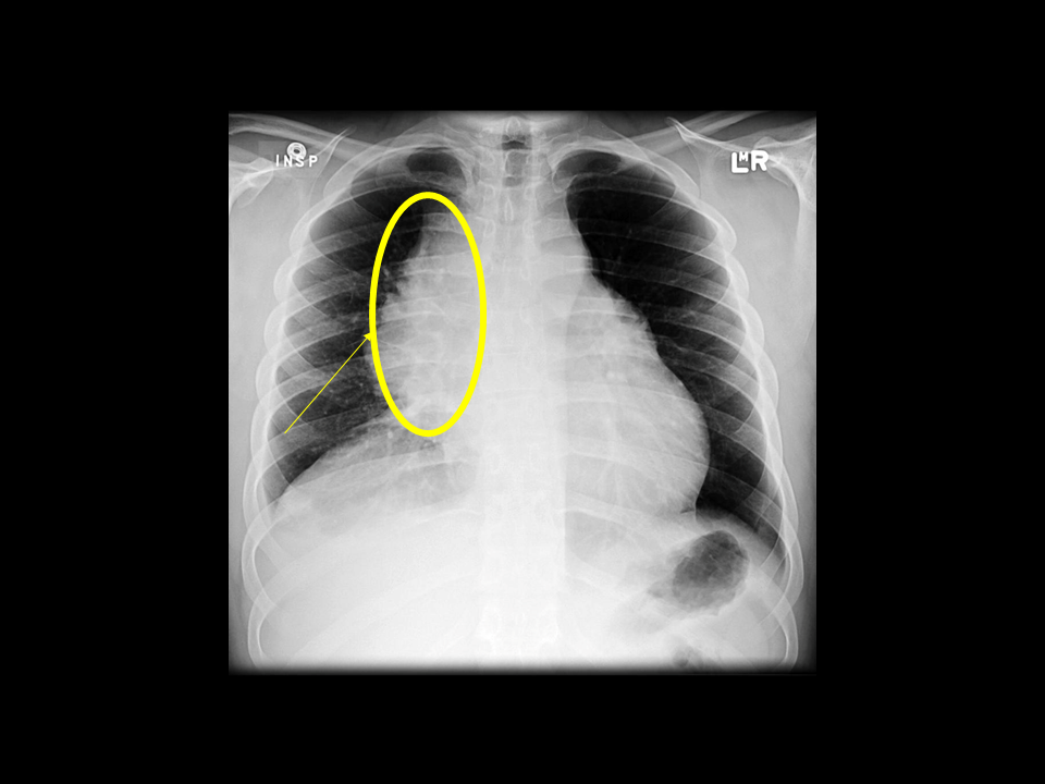 Primary Mediastinal B Cell Lymphoma Survival Rate