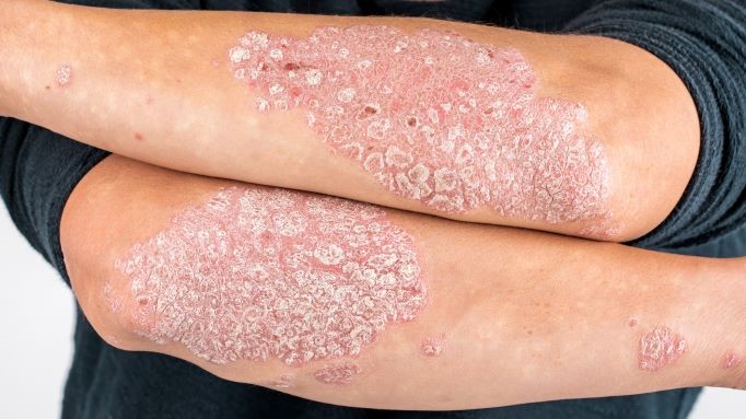 Psoriasis - Dermatologist consultation online - iDerma - Can Psoriasis Cause High White Blood Cell Count