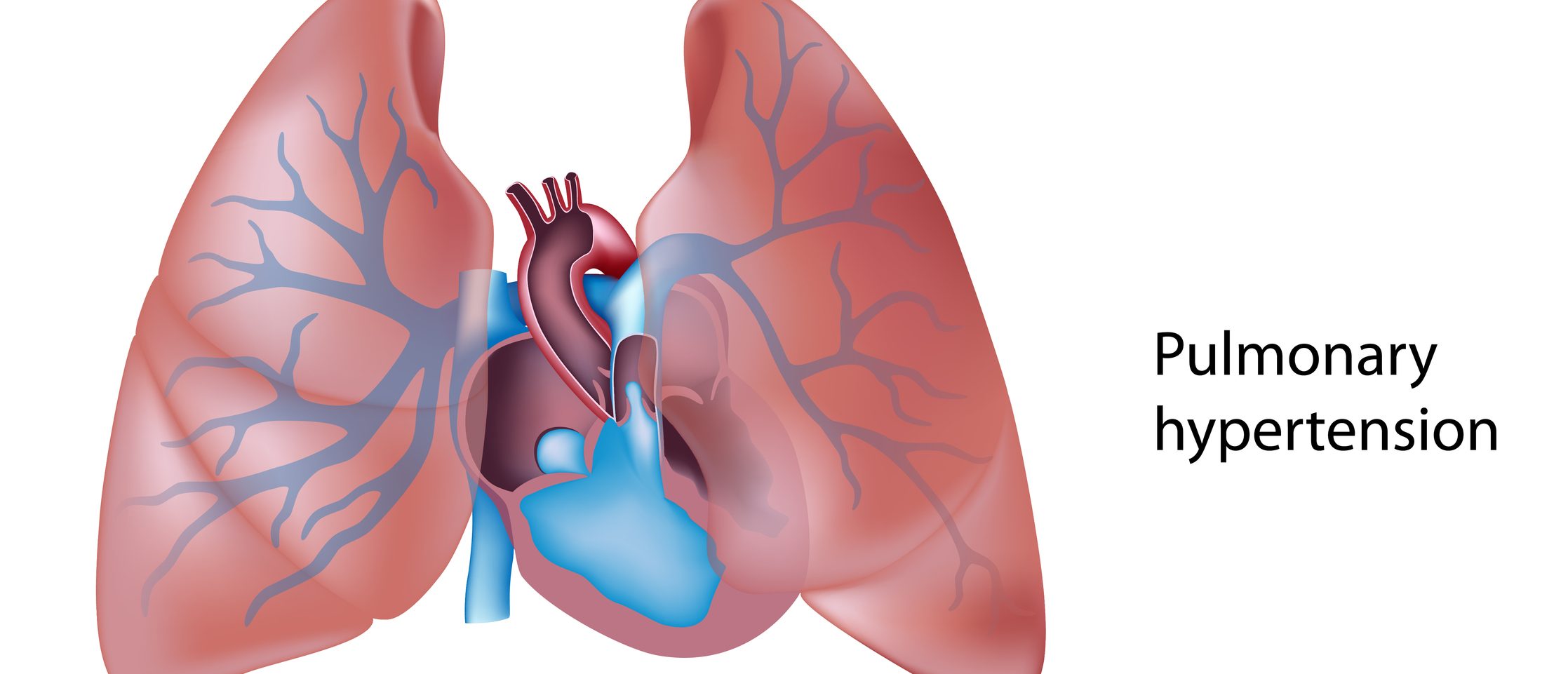 Pulmonary Hypertension Explained by a Cardiologist • MyHeart - Pulmonary Hypertension And Right Heart Failure