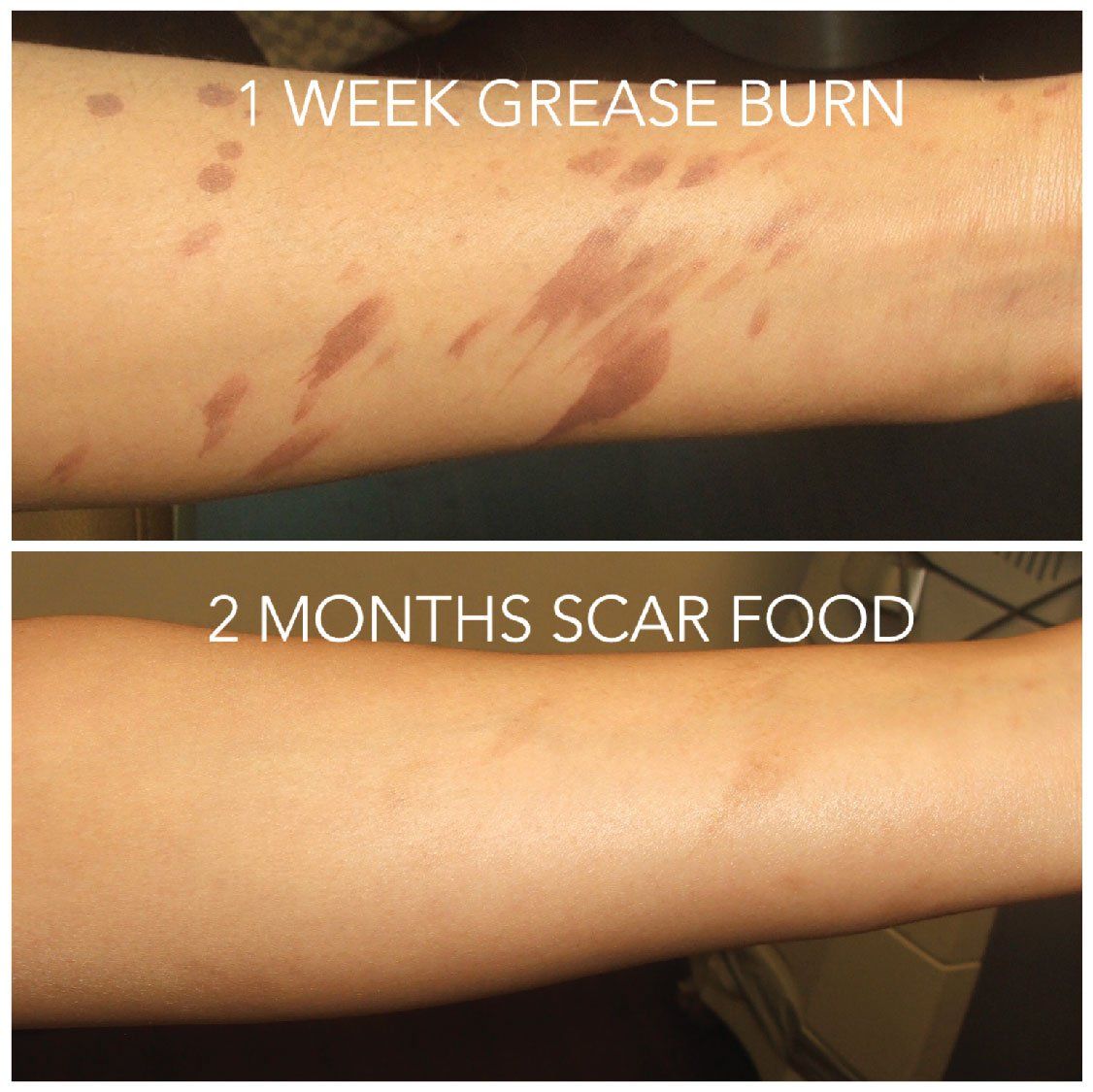 Does Taking Collagen Increase Scar Tissue