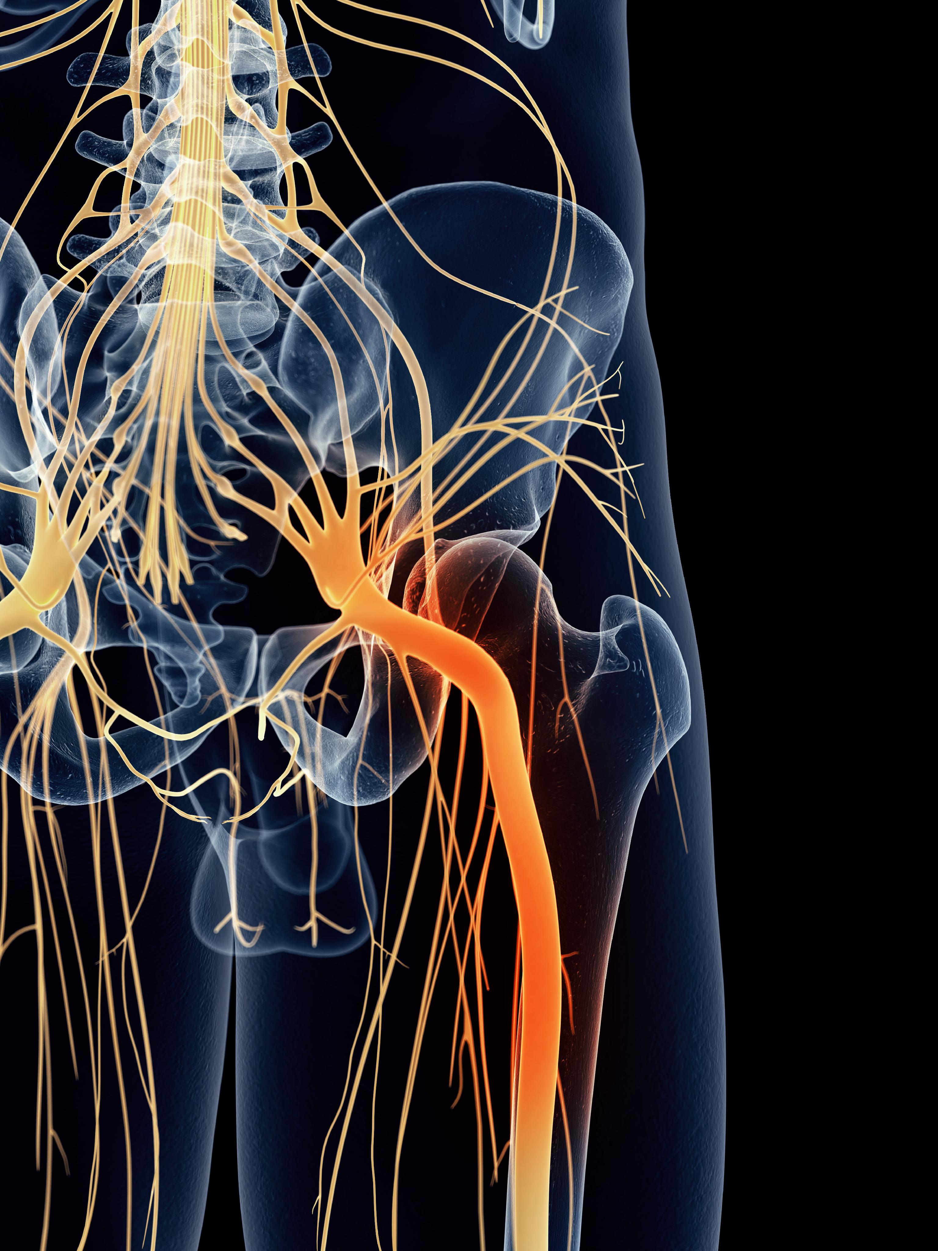 Sciatica Monitoring For Changes Or Improvement