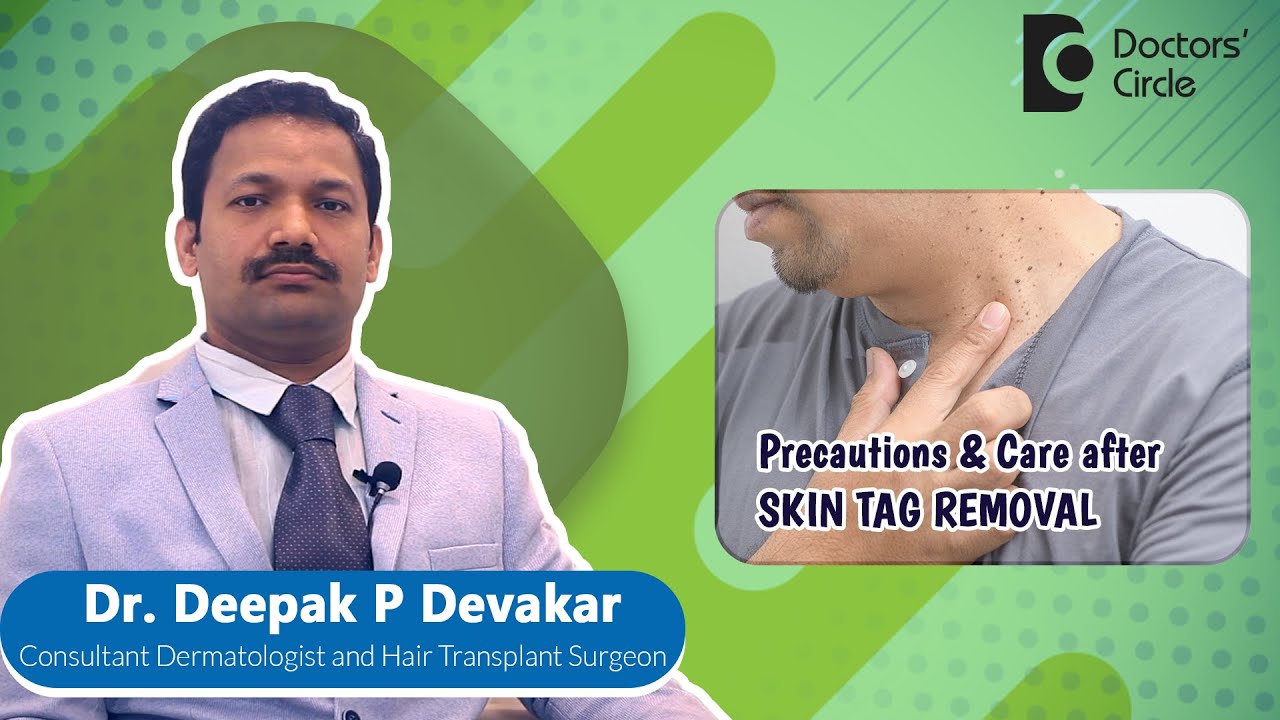 SKIN CARE After LASER SKIN TAG REMOVAL | Radiofrequency Laser - Dr - Derma Clear Skin Tag Remover Reviews Before And After