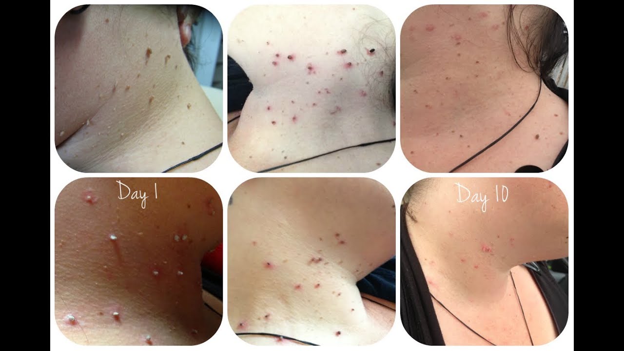 Skin tag removal - part 1 application - YouTube - Forces Of Nature Skin Tag Removal