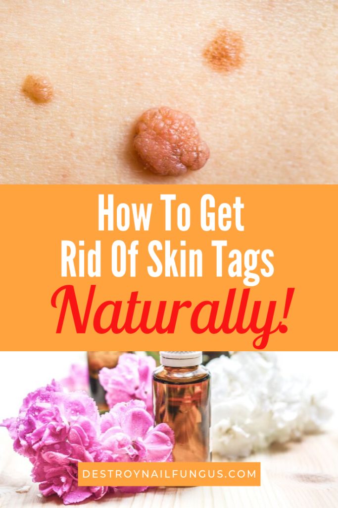 Forces Of Nature Skin Tag Removal