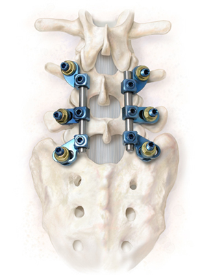 Alliance-spine New Product Launches Spine Implants