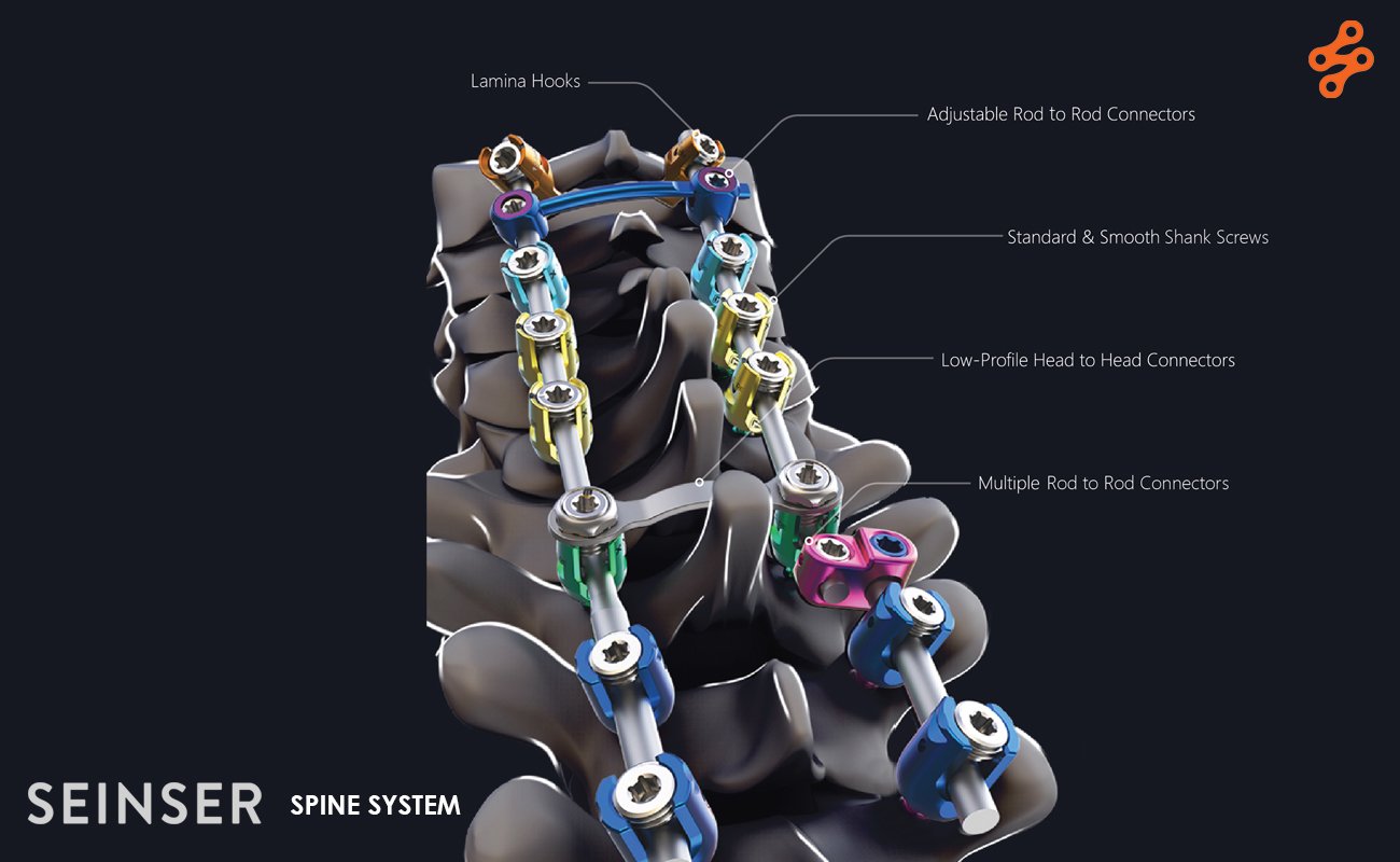 Spine implants - Alliance-spine New Product Launches Spine Implants