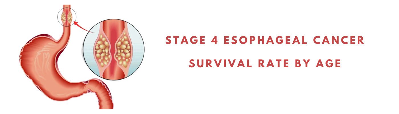 Squamous Cell Carcinoma Esophagus Survival Rate - Infoupdate.org - Stage 4 Esophageal Cancer Survival Rate By Age