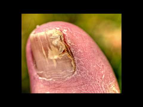 Toe Nail Fungus Solution: Toe Fungus Treatment Epsom Salt - YouTube - Does Epsom Salt Help Infected Toe