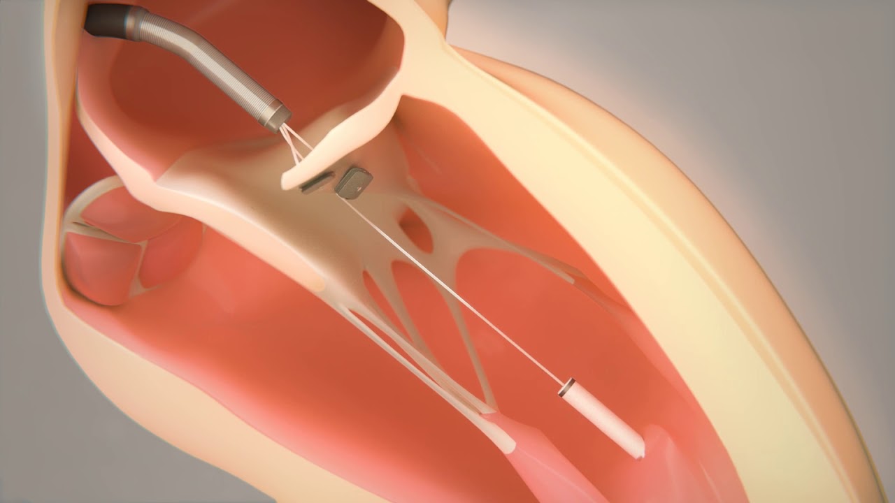 Transcatheter Mitral Valve Repair Pipeline Product Market