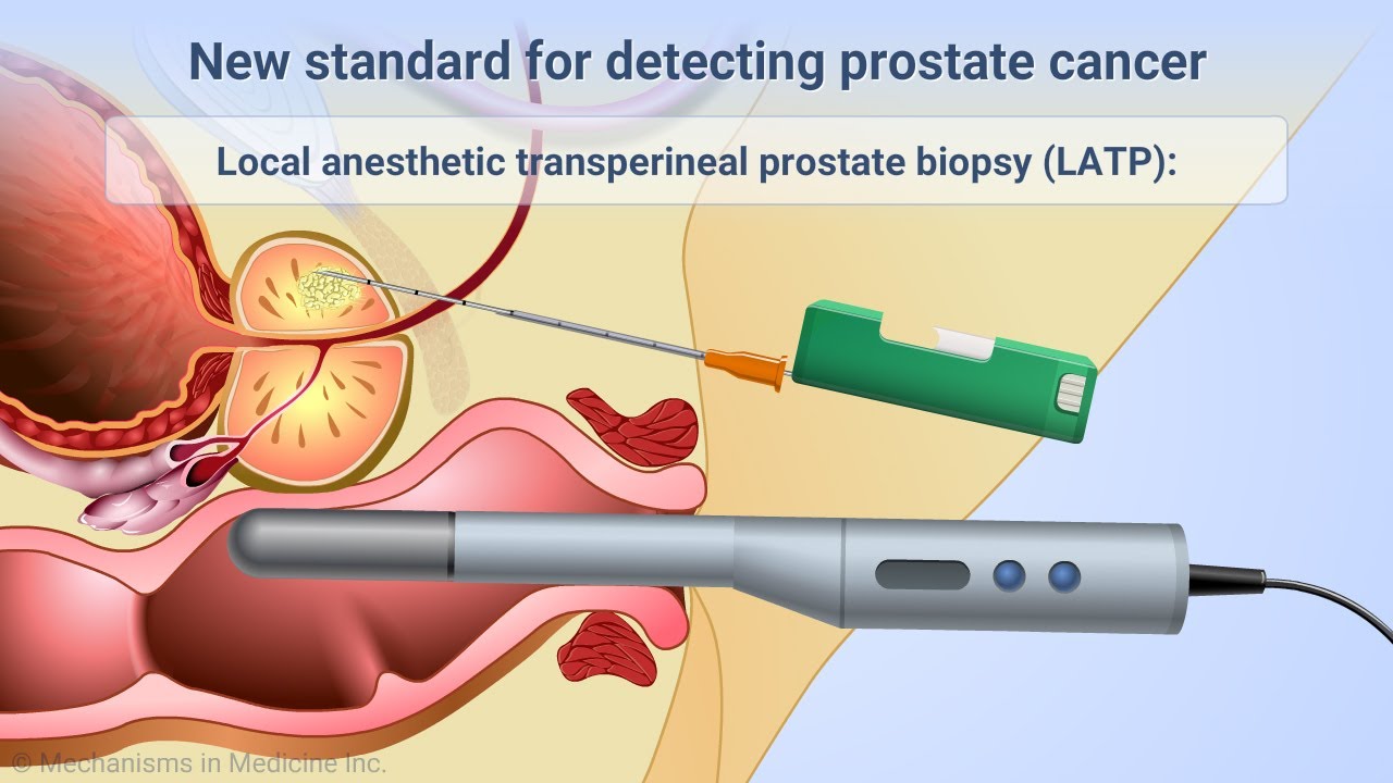 Transperineal Prostate Biopsies Under Local Anesthesia - YouTube - Cpt Code For Transperineal Prostate Biopsy