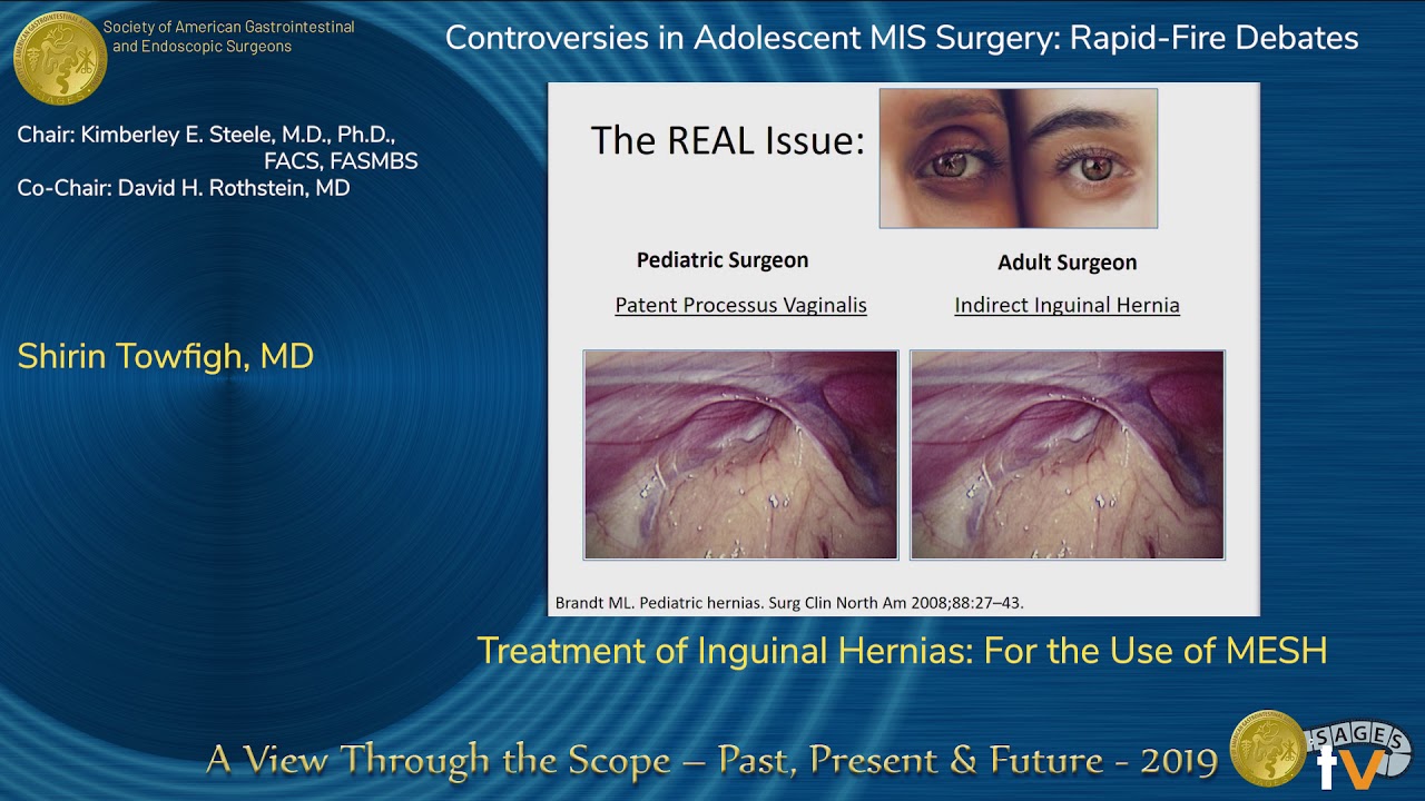 Treatment of Inguinal Hernias: For the Use of MESH - YouTube - Seroma After Inguinal Hernia Repair With Mesh
