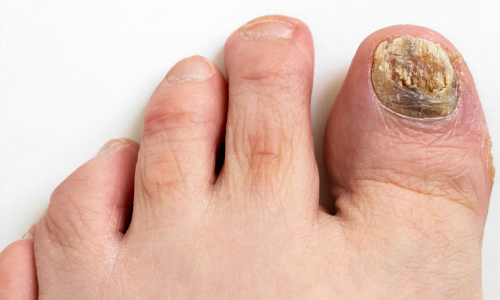 Treatment Types Of Toenail Fungus Outlet | cityofclovis.org - Tolnaftate Vs Undecylenic Acid For Toenail Fungus
