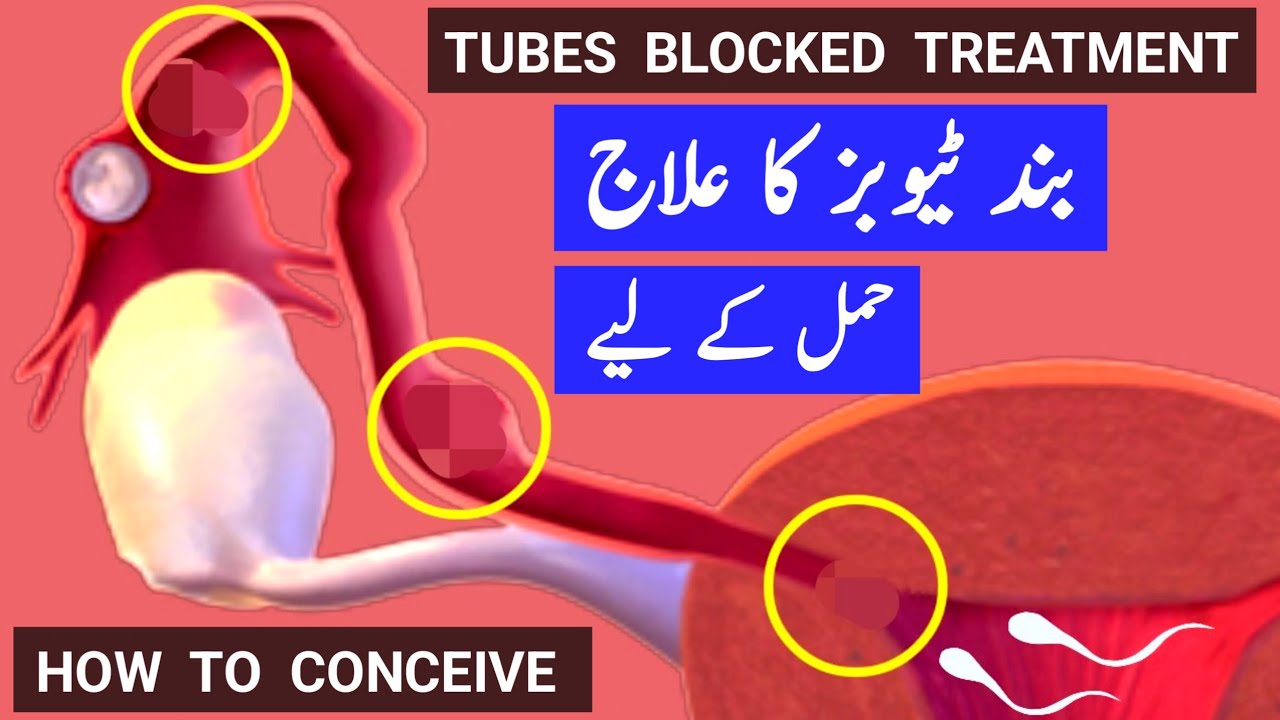 Tubes Blocked Treatment |How To Conceive Pregnancy With Blocked - Miracle Pregnancy With Blocked Fallopian Tubes