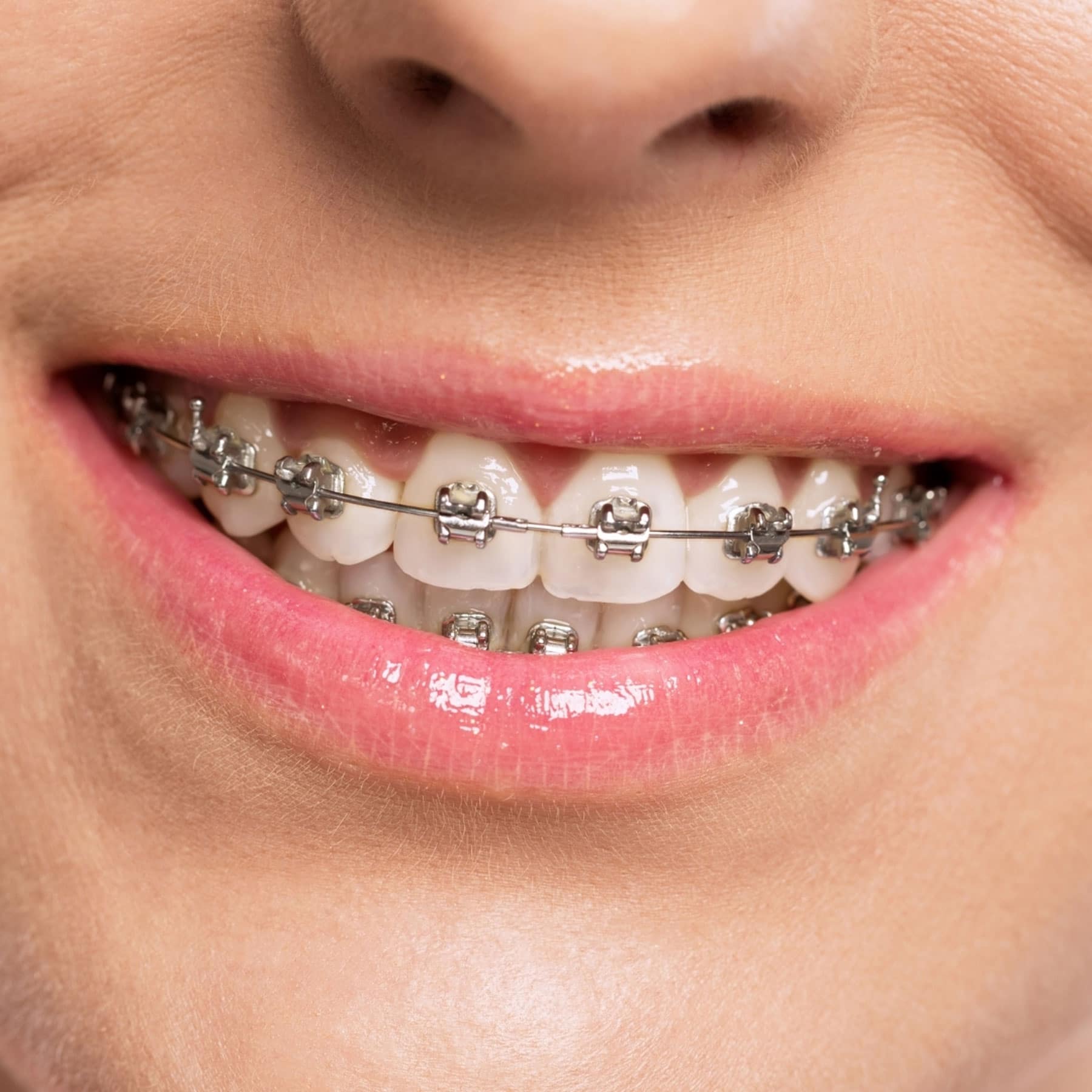 Can Braces Make You Lose Weight