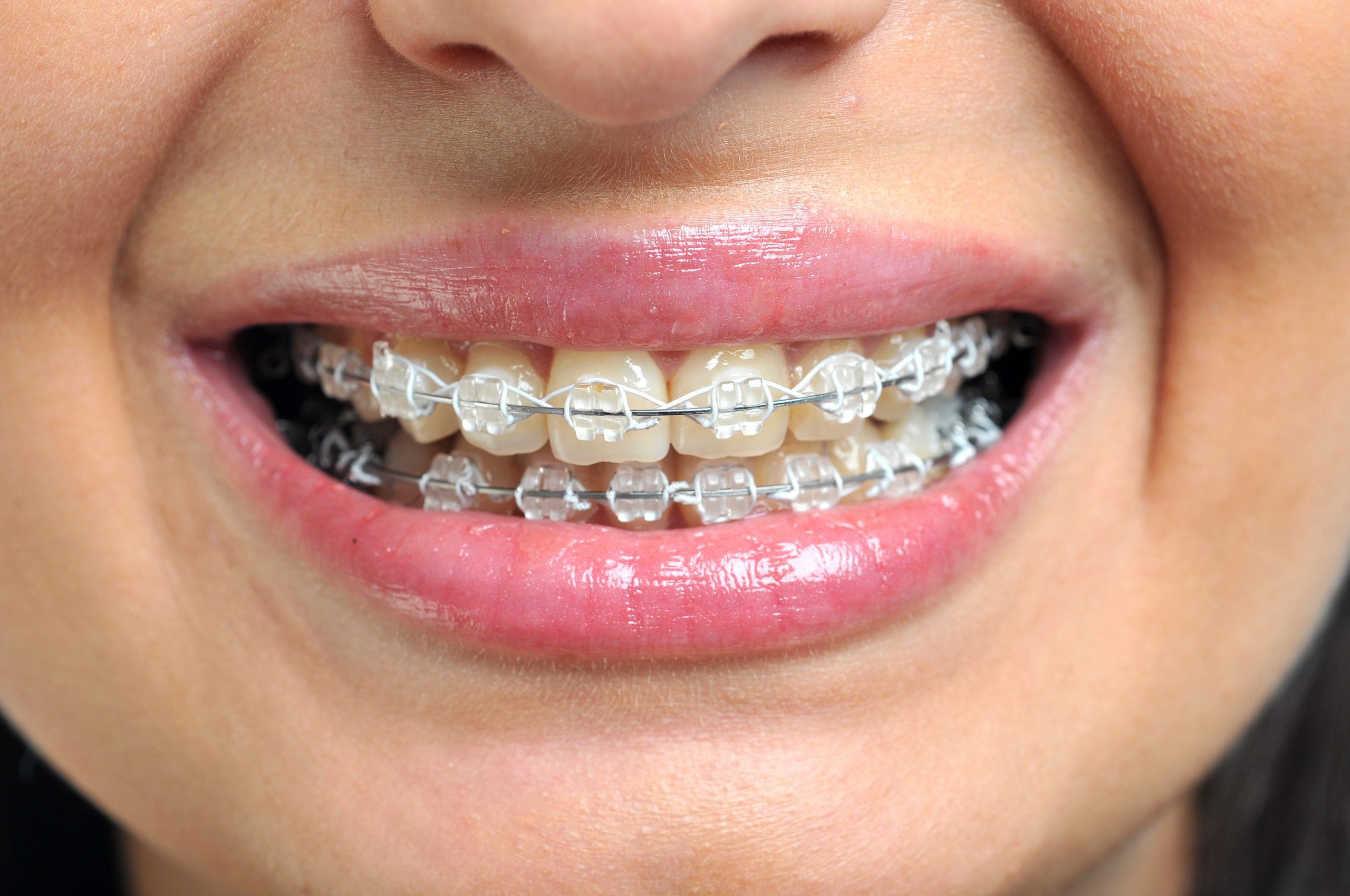 Understanding Metal Braces for Orthodontic Treatment - Can Braces Make You Lose Weight