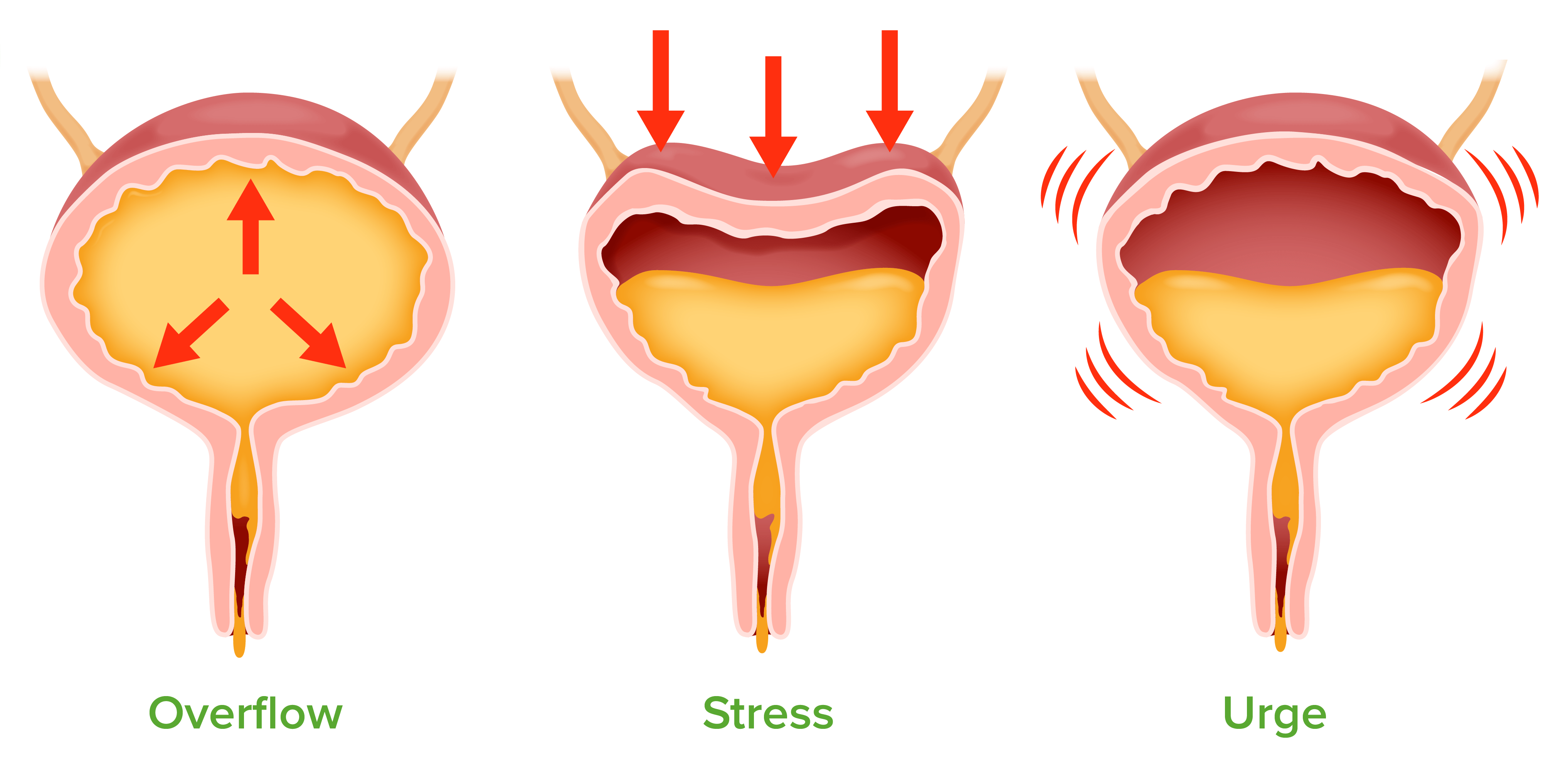 Urinary Incontinence | Concise Medical Knowledge - Incontinence Devices Medical Devices Pipeline Product Analysis