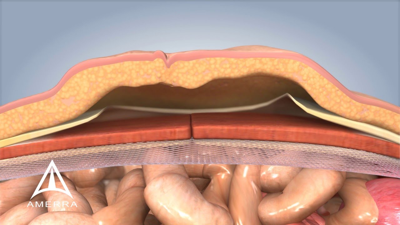 Seroma After Inguinal Hernia Repair With Mesh
