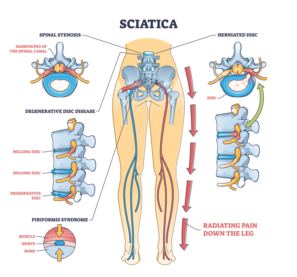 What Is Sciatica? Types of Sciatica, Treatment | Premia Spine Blog - Sciatica Monitoring For Changes Or Improvement
