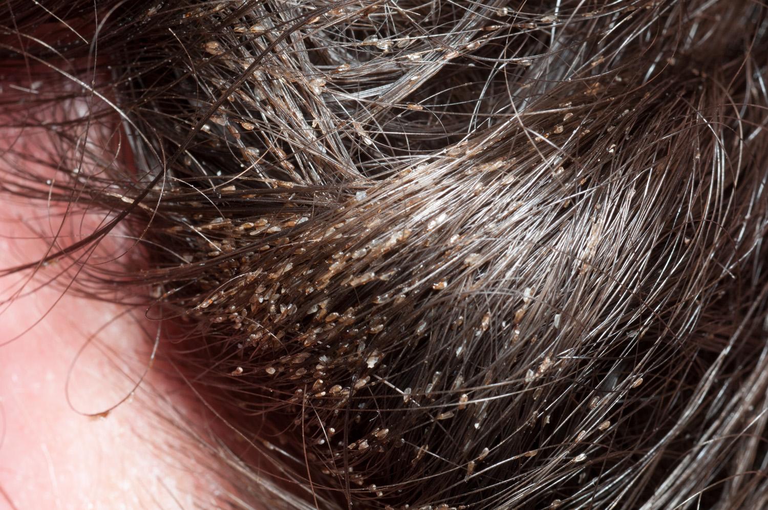Lice Clinics Of America Austin Tx